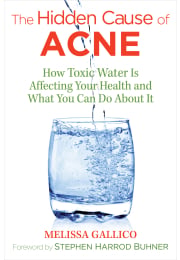 The Hidden Cause of Acne